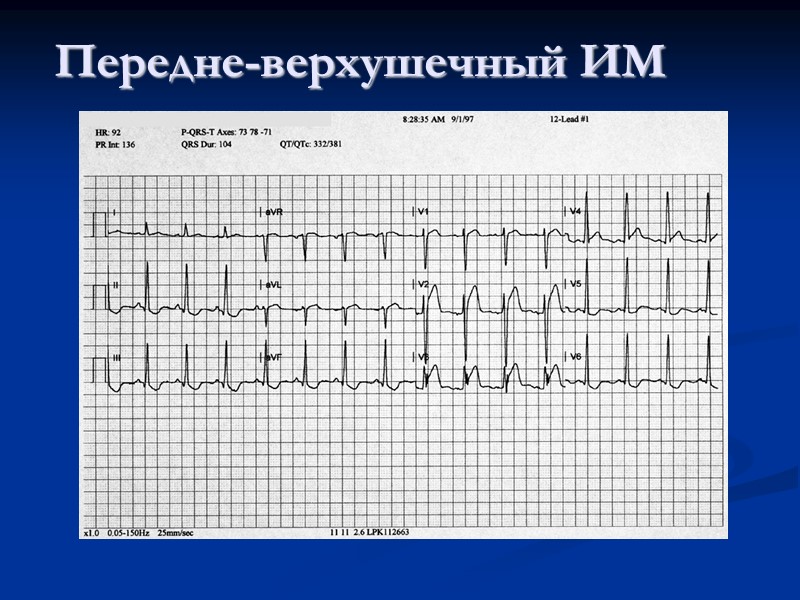 Передне-верхушечный ИМ